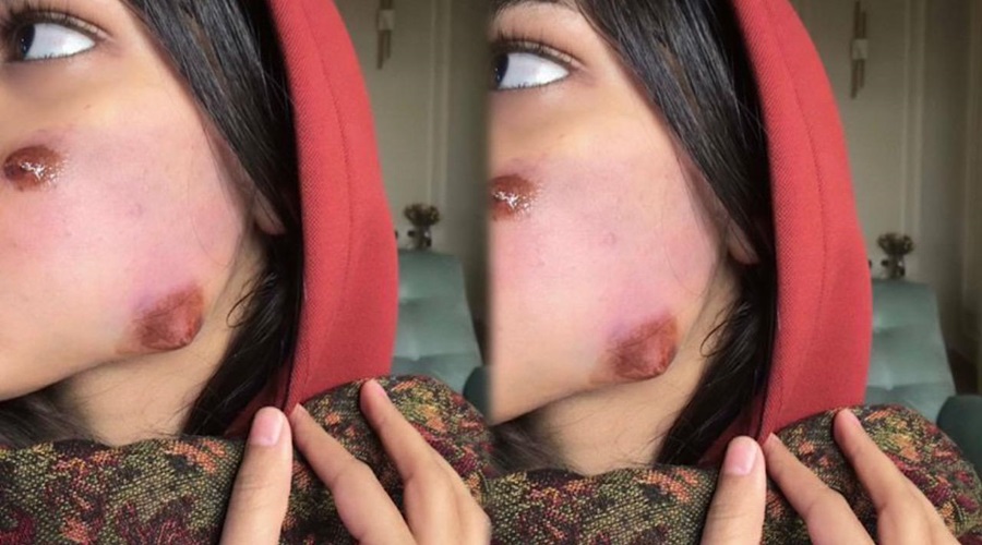 مرض غناتي القحطاني