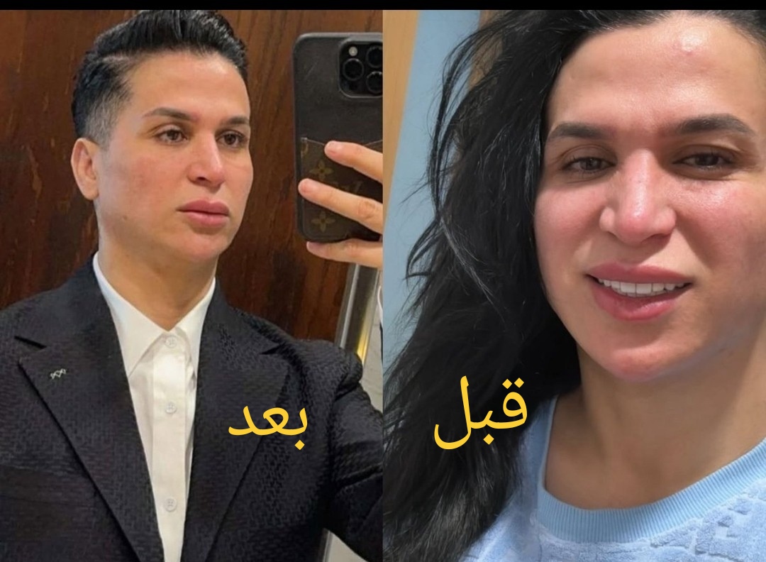 صوفيا طالوني قبل وبعد التجميل